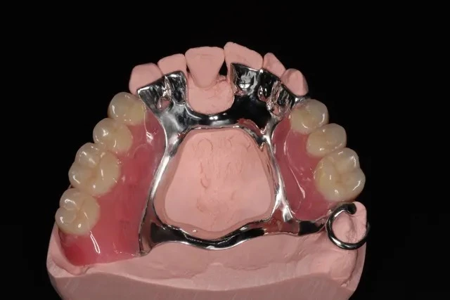 Removable Partial Denture