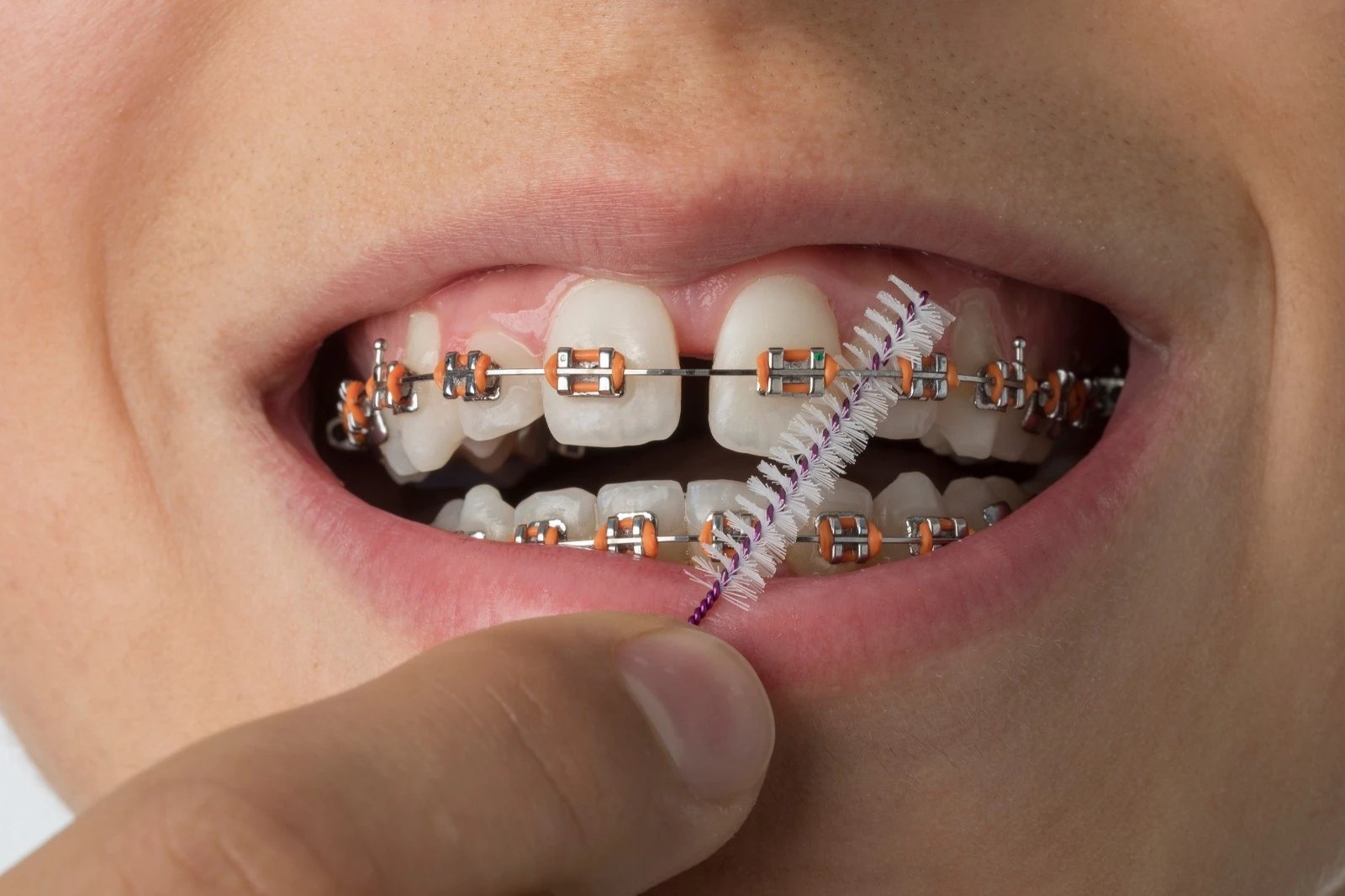 Fixed Orthodontic Appliances