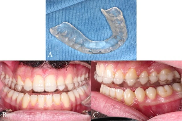 TMJ / Orthotic Appliances