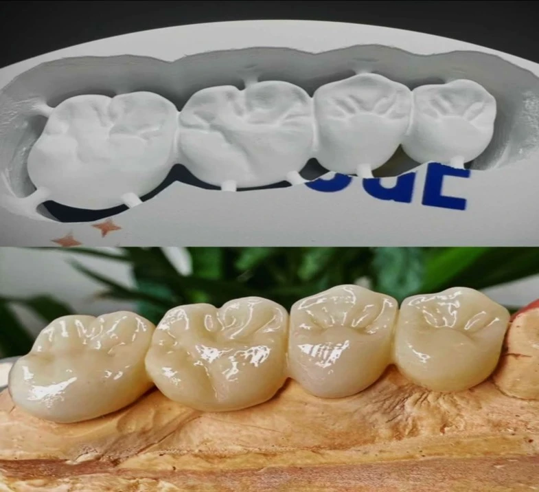 Fixed Restorations (Crowns & Bridges)