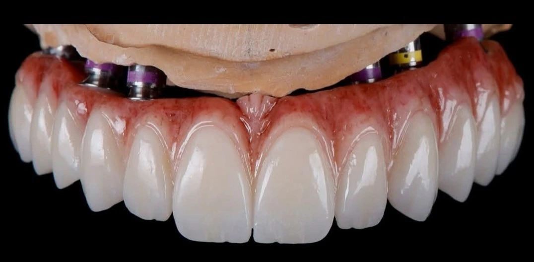 Implant Solutions