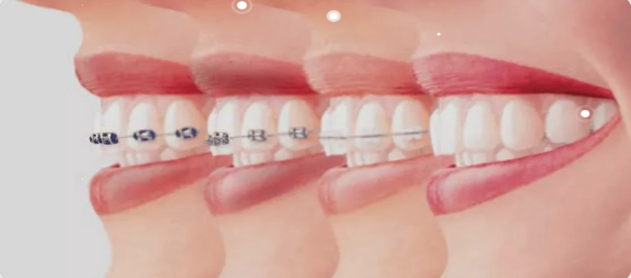 Fixed Orthodontic Appliances