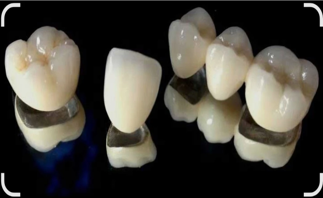 Metal Ceramic Classic
