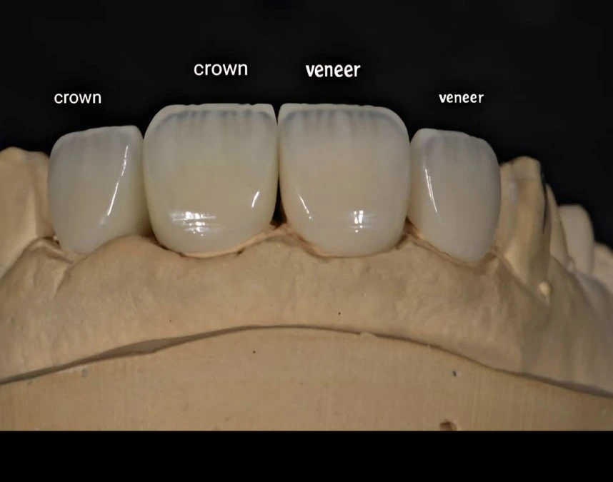Zirconia Crown