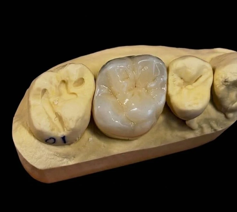 IPS e.max Crown