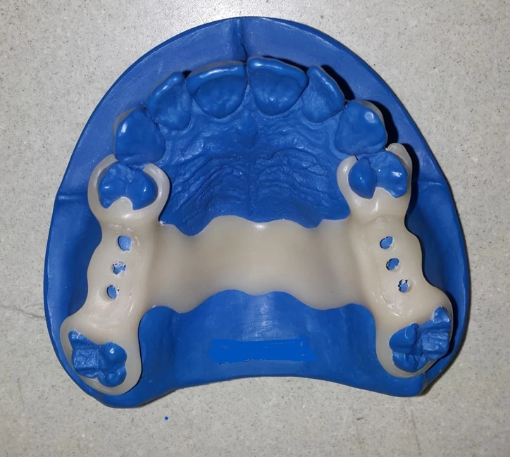 Metal-free partial dentures: hygienic, flexible, and unbreakable.
